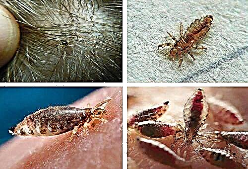 Ways to get rid of lice lice available at home